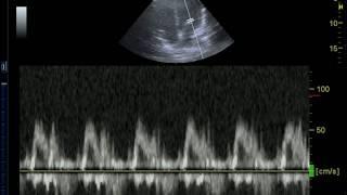 Acquiring the Mitral Inflow View with Pulse Wave Doppler for Diastolic Dysfunction Evaluation