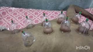hijama l hijama therapy l hijamah l hijama treatment hijama l cupping therapy l dr arif malik