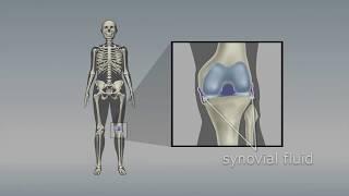 Osteoarthritis of the knee: Choosing the right pain medicine