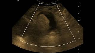 Complex Adnexal Mass - Dermoid Cyst || Ultrasound || Case 23