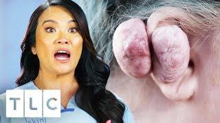 Dr. Lee Removes 14 Oz Keloid From Woman's Ear | Dr. Pimple Popper