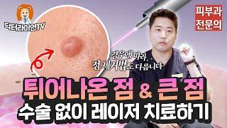 튀어나온 큰 점! 수술 없이 레이저 치료하세요!ㅣ닥터라이언TV