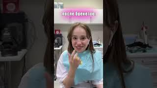 КАК МОЯ ЖИЗНЬ ИЗМЕНИЛАСЬ С БРЕКЕТАМИ #shorts #tiktok # a4 #брекеты