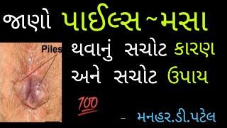 જાણો પાઈલ્સ, મસા થવાનું સચોટ કારણ અને સચોટ ઉપાય  || Manhar.D.Patel Official