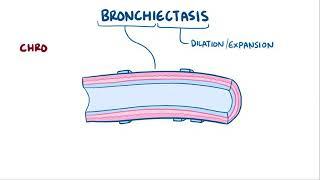 Bronchiectasis