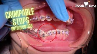 Braces on - crimp stop application - coil springs - Tooth Time Family Dentistry New Braunfels