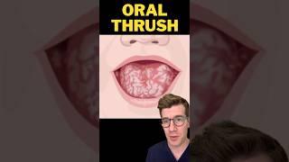 Doctor explains ORAL THRUSH in babies #shorts