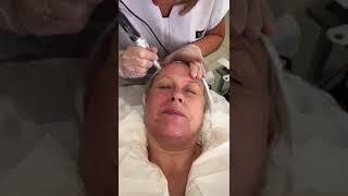 Collagen P I N treatment video at Skin Perfection London