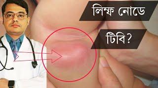 লিম্ফ নোডে টিবি?  Bangla Health Education/Dr.Joydeb Singha