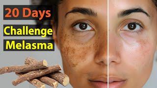 20 Days Challenge Permanent Pigmentation, MELASMA removal at home | Best Pigmentation Removal Cream