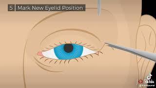 Procedural Steps for Lateral Tarsal Strip Procedure for Left Lower Eyelid Entropion