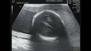 20 weeks pregnancy/ ultrasound/ anamoly scan/anatomy scan