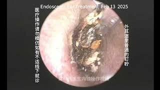 Re examination and cleaning of external auditory canal cholesteatoma 20250213