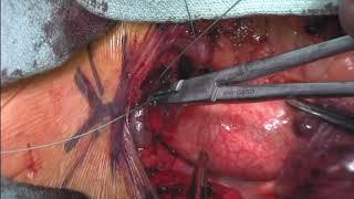 Aortic Cannulation for Cardiopulmonary Bypass (Ross M. Reul, MD, M. Mujeeb Zubair, MD)