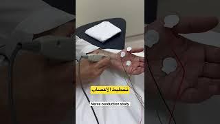 تخطيط الأعصاب nerve conduction study