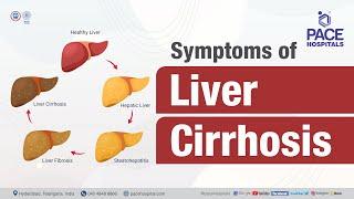 What are the symptoms of Liver Cirrhosis? | PACE Hospitals #shortvideo  #livercirrhosis