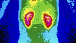 A Man Took 1176 Ibuprofen Tablets In A Month. This Is What Happened To His Kidneys.