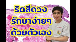 ริดสีดวงทวาร รักษาด้วยตัวเองง่ายๆ l 10นาทีกับหมอต่อ