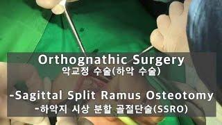 양악수술 동영상 - Sagittal Split Ramus Osteotomy(SSRO)