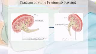 Patients' Corner Series  Postural Drainage with Percussion to Aid Passage of Stone Fragments after L