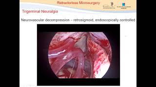 Retractor less Microsurgery of the Posterior Cranial Fossa | Neurosurgical TV