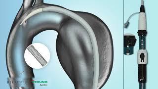 RelayPro NBS   Deployment Animation   Terumo Aortic