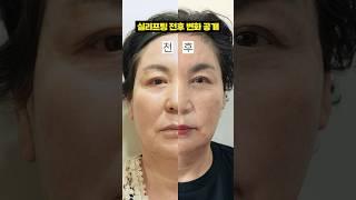실리프팅 전후 변화 비교!! 얼굴 리프팅 효과는?