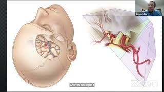 Reducing surgical footprint in aneurysm/Dr. Ramesh Nair
