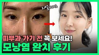 피부과 NO! 모낭염 완치 후기, 이걸 왜 이제 알았을까!ㅣ모낭염과 여드름 관리법,구분법 모두 공개!