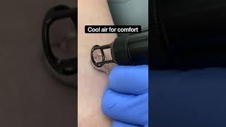 Laser Tattoo Removal