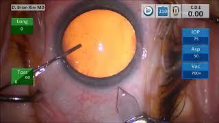 Updated Triplanar Corneal Incision Technique: Is this Better?