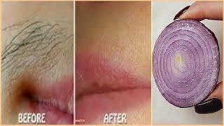 Only 1 onion get rid of facial hair permanently fast / unwanted hair removal permanent quickly