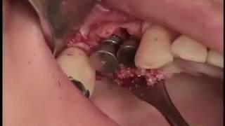 biotem implant   손동석 교수님  시술영상