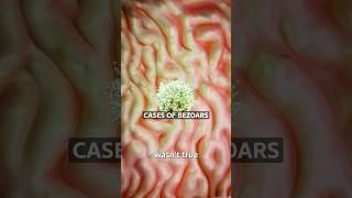 Why Hair Stones Were Used As Medicine  Surgeon Reacts