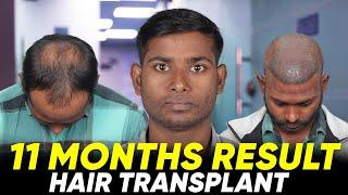 Hair Transplant in Salem | Best Results & Cost of Hair Transplant in Salem