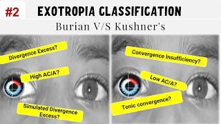 Classification of Exotropia | All you need to know