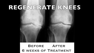 REGENERATE YOUR KNEES (no surgery needed) #18 | https://drstephenstokes.com