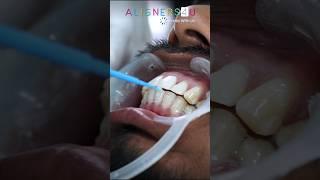 Get Perfect Smile Makeover  With Best Clear Aligners Treatment In Hyderabad | Aligners4u | Braces