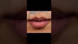 입술축소를 고민해보셨나요? Korea Lip Reduction Surgery