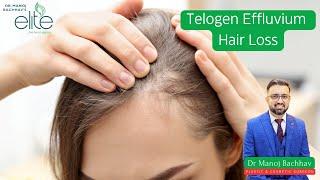 Telogen Effluvium: Causes, Symptoms, and Effective Management | Dr. Manoj Bachhav Explains