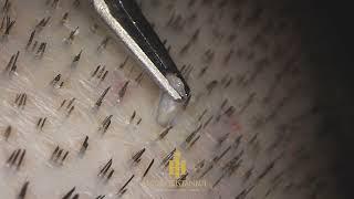 FUE Hair Transplantation Surgery (Maximum Zoom) #hairtransplant #fuemethod #hairofistanbul