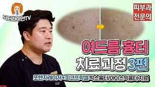 포텐자레이저+피코프락셀 박스흉터/송곳모양/패인흉터 치료과정 3편