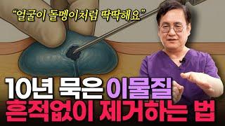 "이물질 제거하다 큰일 납니다" 불법 시술을 받으면 위험한 이유