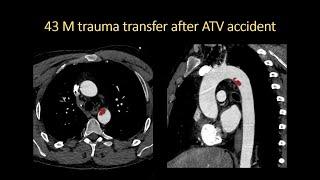 Aortic Trauma by Jody Shen, MD, Stanford Radiology