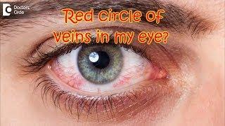 How do I get rid of the orange/red circle of veins in my eye? - Dr. Sriram Ramalingam