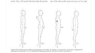 How to Correct Swayback Posture