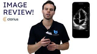 Clarius PAL HD3 Ultrasound Image Quality Review