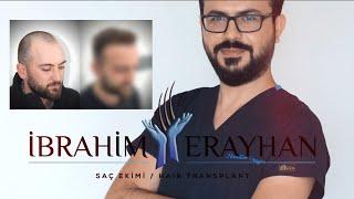 Saç Ekimiyle 2 Yıl Sonrasında Harika Değişim | Wonderful Change After 2 Years With Hair Transplant