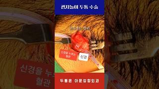 관자놀이 두통 수술 live (편두통 신경 감압술 nerve decompression 아문성형외과)[아문TV]