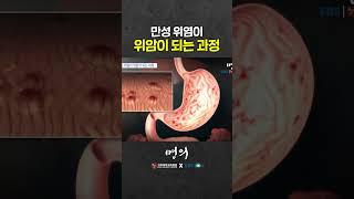 How does gastritis become stomach cancer?